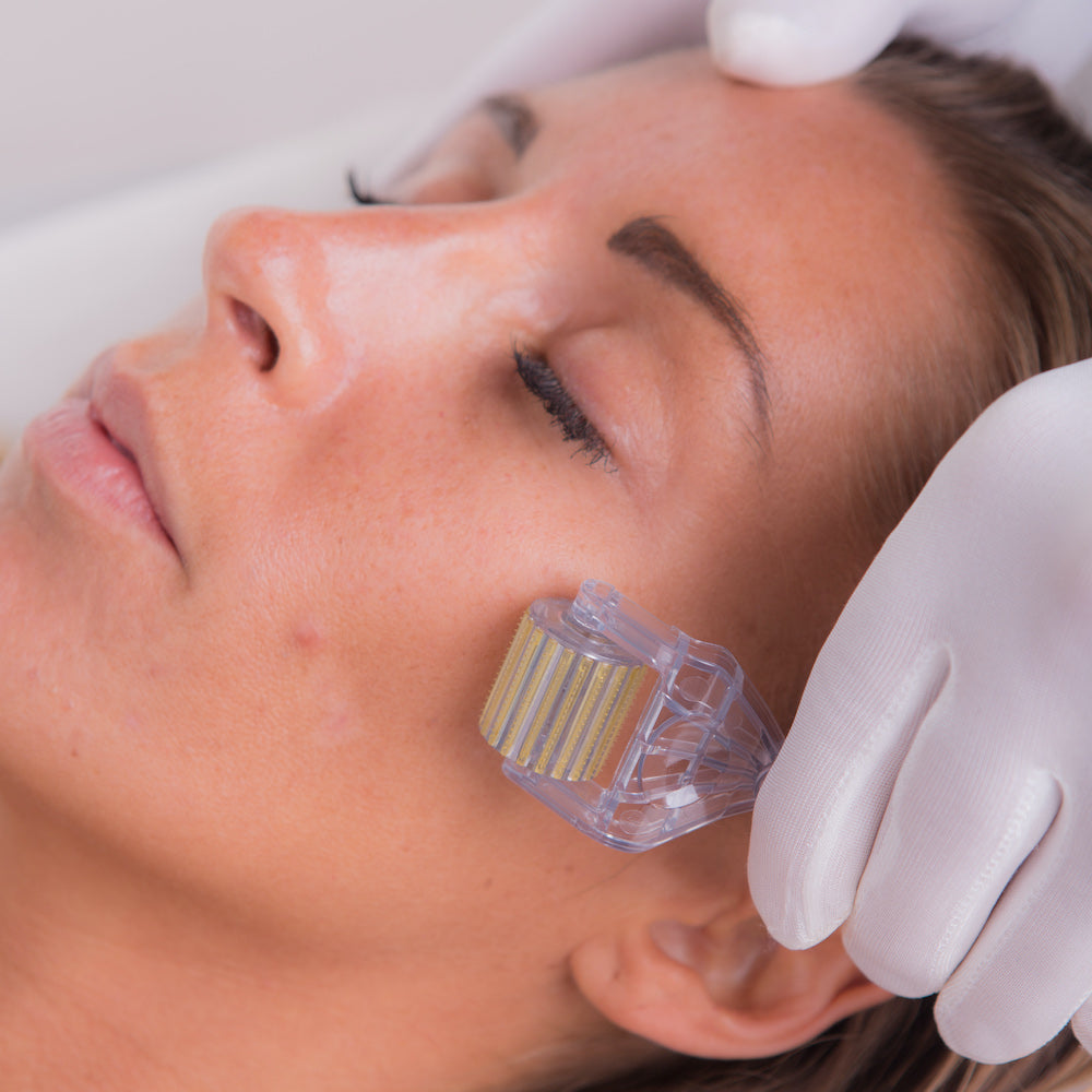 Microneedling for Acne Scars - Derma Roller Acne Scars